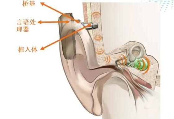 骨传导助听器