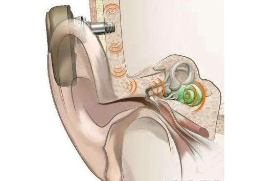骨传导助听器适用哪些人群